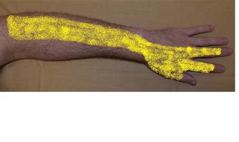 Radial Nerve Palsy Wrist Drop Neuromuscular And Electrodiagnostic