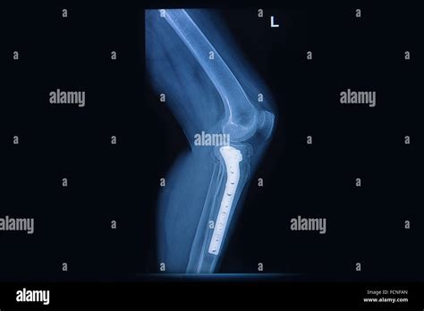 X Ray Of Fracture Tibialeg Bone Tibia Bone With Internal Fixed By