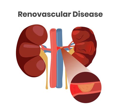 Renovascular Hypertension — Vascular Cures