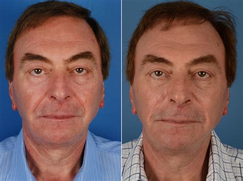 Nasolabial Folds Before And After