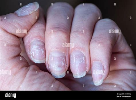 Close Up Of Brittle Nails Damage To The Nail After Using Shellac Or