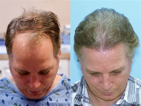 Successfully treated over 3.5 lakh hair loss patients. 3500 Grafts - Norwood Hair Loss Classification V ...