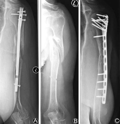 Fracture Of The Humeral Shaft After Car Crash Initially Treated With