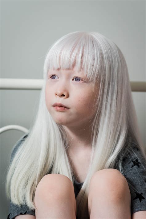 My Experience Adopting A Child With Albinism The Everymom