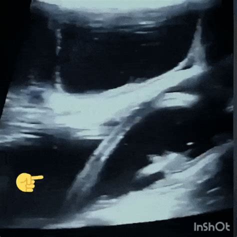 Intestinal Ascariasis On Point Of Care Ultrasound Pocus Ultrasound Grepmed
