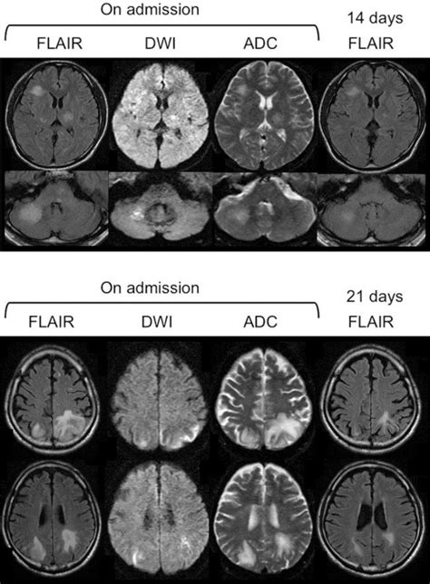 Flair Imaging Dwi And Adc Mapping The Upper Panels Show Mri Findings