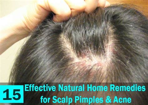 15 Effective Natural Home Remedies For Scalp Pimples And Acne Pimples
