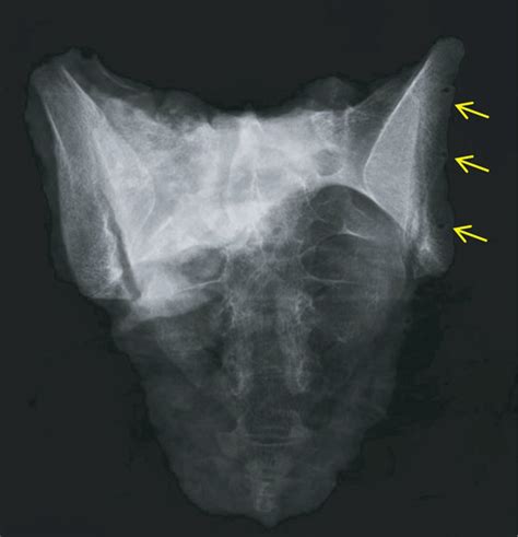 An Illustrative Case Of Sacral Osteosarcoma Patient No 1 The Mri