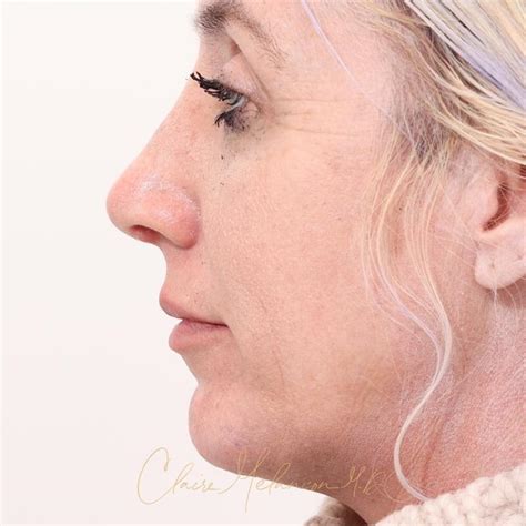 Before And After Rhinoplasty And Chin Augmentation In New Orleans