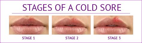 Canker sores usually appear inside your mouth, while cold sores appear. Canker & Cold Sores which act as hot sores | Dr ...