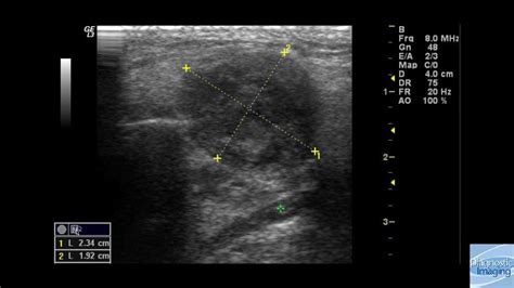 Enlarged Cervical Lymph Nodes Diagnostic Imaging