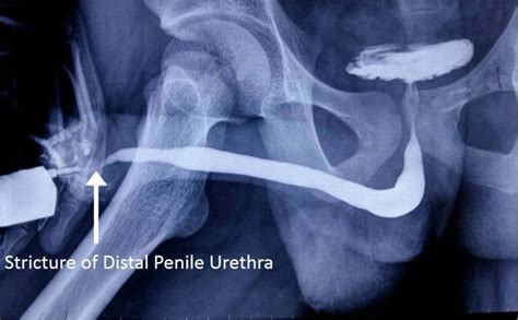 Stricture Urethra