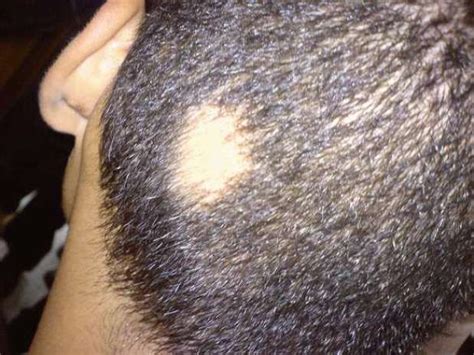 How To Treat Alopecia Areata Sudden Bald Spot On Head And Beard