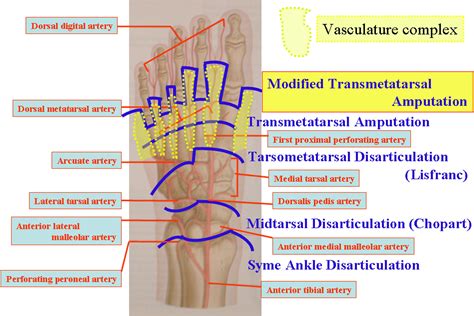 A Modified Transmetatarsal Amputation The Journal Of Foot And Ankle