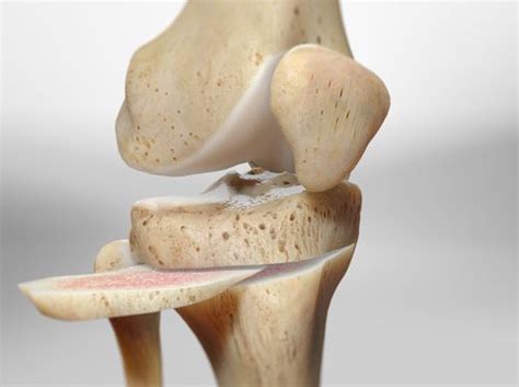 Video Osteotomy Of The Knee High Tibial Osteotomy Healthclips Online