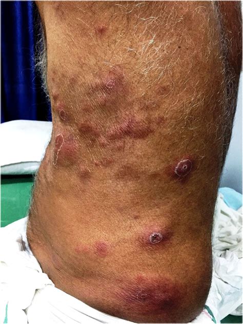 The Rash With Painful And Erythematous Nodules Clinics In Dermatology