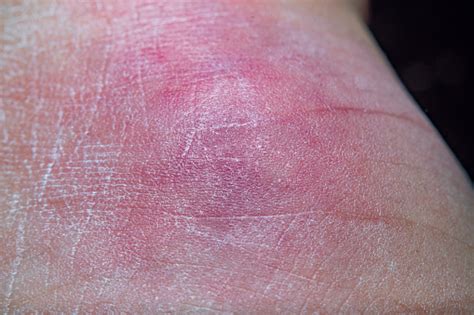 Large Hematoma On The Leg From A Swollen Joint Stock Photo Download