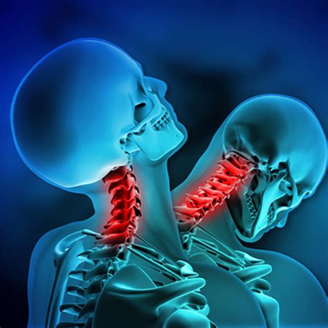 Whiplash Injuries The Upper Cervical Spine Center Chiropractor