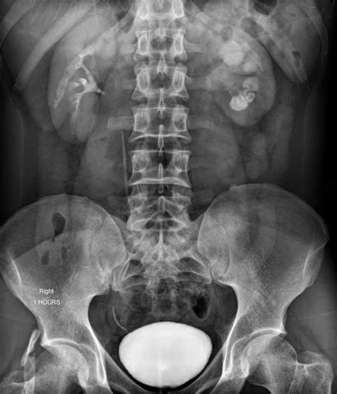 Hydronephrosis Radiology Reference Article