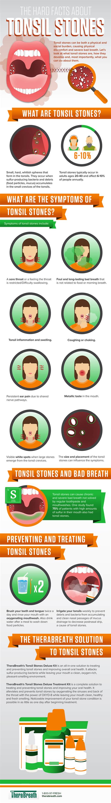 The Hard Facts About Tonsil Stones Infographic