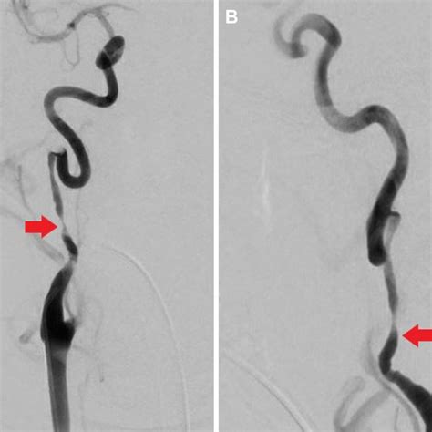 Digital Subtraction Angiography Of Carotid Artery Dissection A Coronal