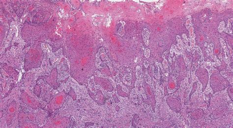 Squamous Cell Carcinoma Of The Oral Cavity Mypathologyreportca