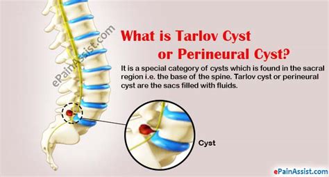 Tarlov Cyst Or Perineural Cystscausessymptomsdiagnosis