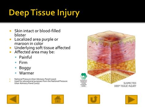 Ppt Pressure Ulcers In The Critically Ill Patient Powerpoint