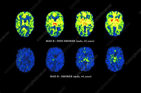 Smoking Brain Scans Stock Image M3700778 Science Photo Library