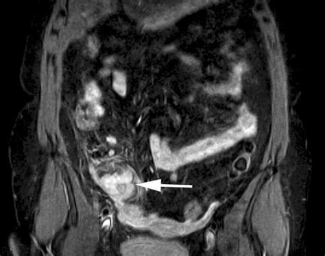 Perforated Appendicitis Visualized By Mri Eurorad