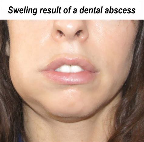 Treatment Of A Dental Abscess Ralev Dental Clinic
