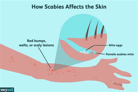 scabies symptoms causes treatment