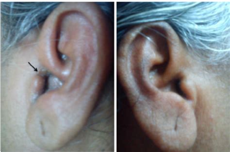 Localized Otitis Externa Furunculosis Definition Causes Symptoms