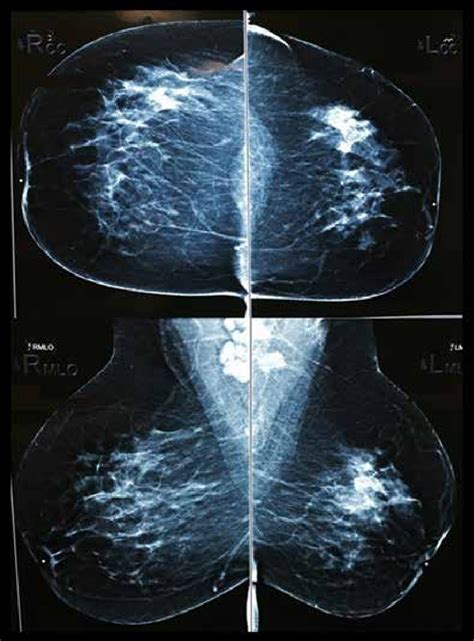 X Plane Mammogram A Focal Asymmetry In Left Breast Upper Outer