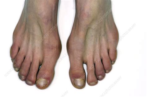 Raynauds And Chilblains Of The Toes Stock Image C0117564