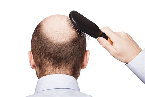 Hairstyles For Balding Crown Faces Oman