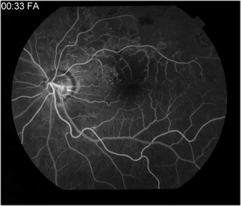 Fluorescein Angiography Eyewiki