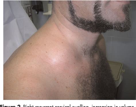 Figure 2 From The Recurrent Cervical Swelling Syndrome Semantic Scholar