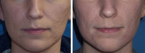 Laser Treatment Of Acne Scars