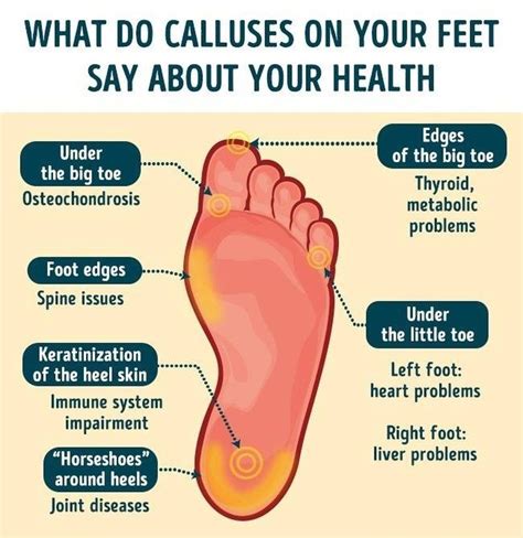 How Do Calluses On Your Feet Say About Your Health Health Facts