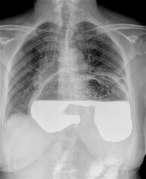 Pa Chest Radiograph Showing Part Of Upper Gi Barium Study Note The