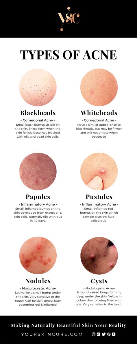 The Ultimate Guide To Acne With Pictures And How To Treat At Home