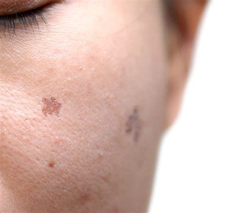 Brown Spots Freckles Dermatology Laser And Vein Specialists Of The