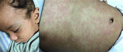 Photographs Of A Measles Patient With Maculopapular Rash Download