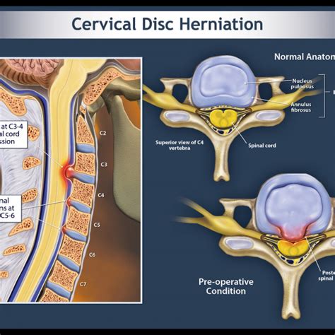Cervical Disc Herniation Trialexhibits Inc