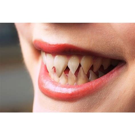 Pinterest Discover And Save Creative Ideas Teeth Sharp Teeth Human