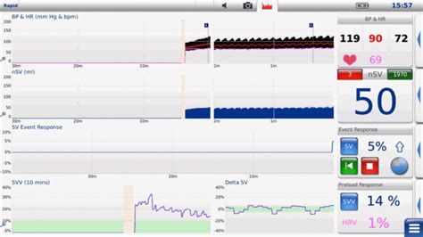 Hemodynamic Monitor Screen Video Lidco Hemodynamic Monitoring For