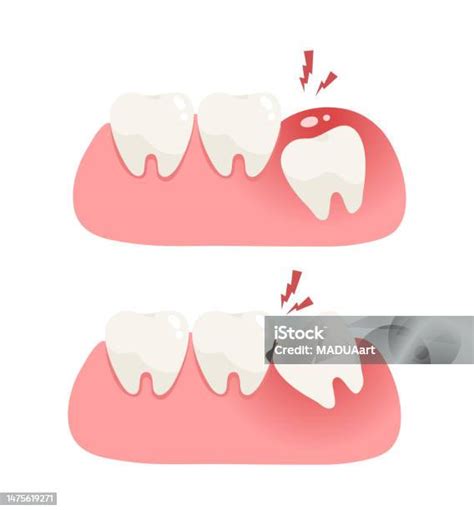 Illustration Of Wisdom Tooth Under Gum Cause Of Pain And Lean On Other