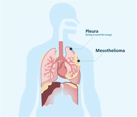 Malignant pleural mesothelioma accounts for most malignant mesotheliomas; Pleural Mesothelioma - Symptoms, Diagnosis & Treatments