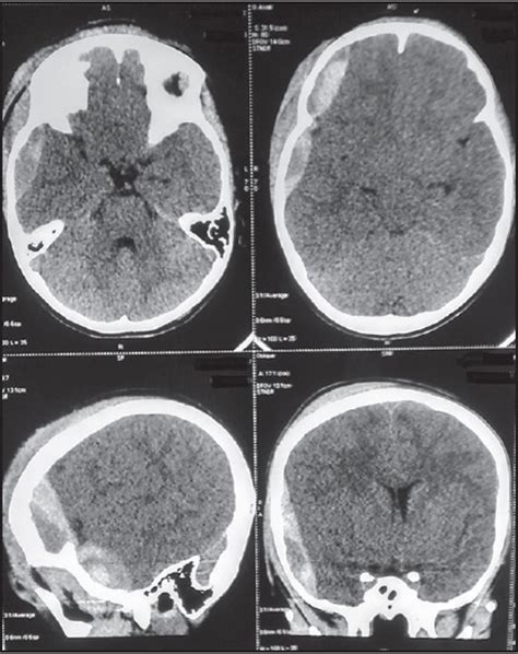 Ipsilateral Double Extradural Hematoma In A Child An Uncommon Case